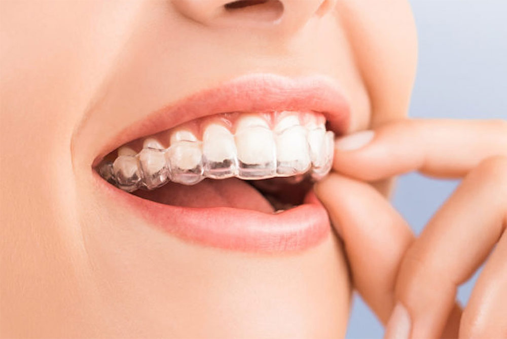 Praxis für Kieferorthopädie Dr. Stil in Mindelheim - Invisalign